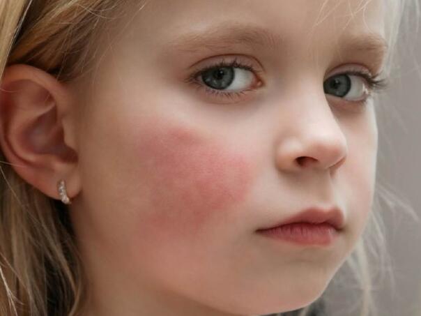 Bolest ispljuskanih obraza kod djece: Zarazna, ali često neprimjetna