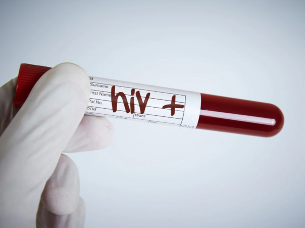 HIV u BiH među mladima u porastu, sve češće se otkriva u terminalnoj fazi