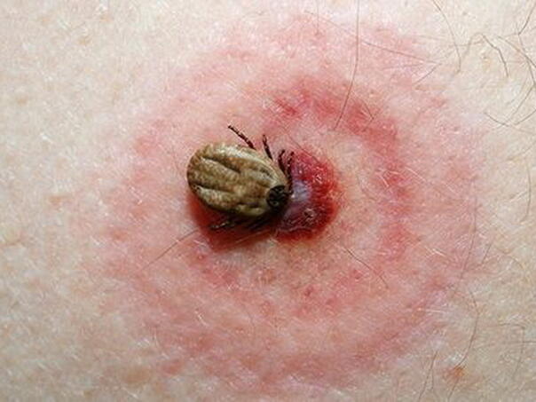 Ujed krpelja – Kako prepoznati simptome lajmske bolesti?