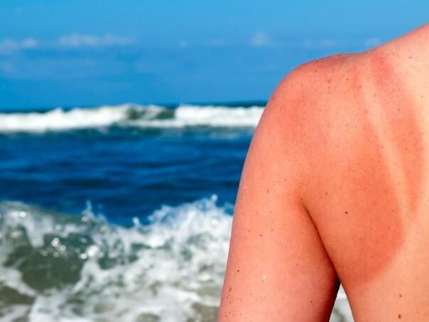 Griješite li? Ovo nikako ne stavljajte na kožu nakon sunčanja