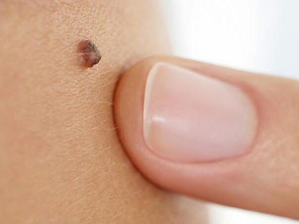 Onkolog objasnio kako da sami pregledamo svoje mladeže