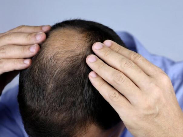 Zašto muškarci ostaju bez kose? Krivci nisu samo geni