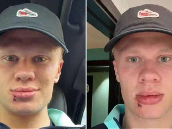 Bizarna nezgoda Haalanda: Vrata autobusa ga udarila pravo u lice